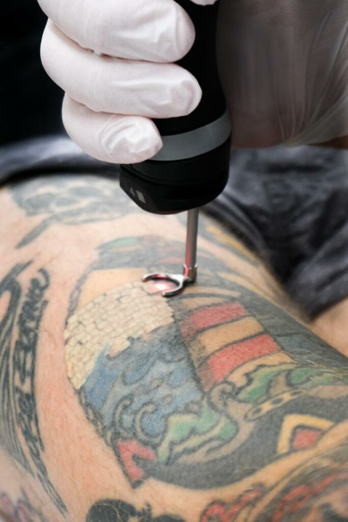Détatouage par Le laser Toro Deka à lyon