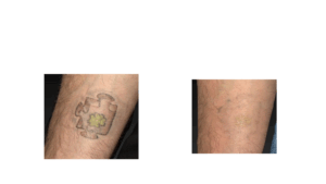 Détatouage par Le laser Toro Deka à lyon, avant après - Exemple 1