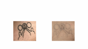 Détatouage par Le laser Toro Deka à lyon, avant après - Exemple 2