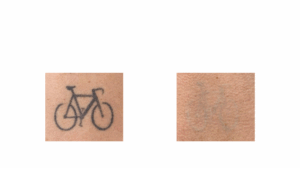 Détatouage par Le laser Toro Deka à lyon, avant après - Exemple 3